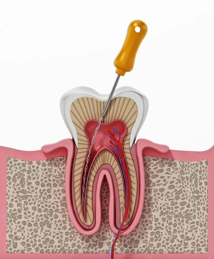 devitalizzazione dente
